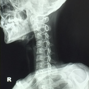 Illustration of straight neck condition showing loss of natural cervical curve and its impact on posture and neck pain